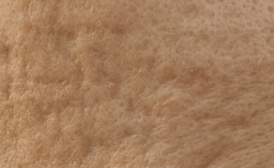 juvelook collagen skin booster for Atrophic Acne Scars - Cienna Aesthetics