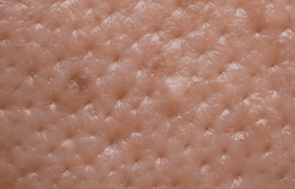 juvelook collagen skin booster for Enlarged Pores - Cienna Aesthetics