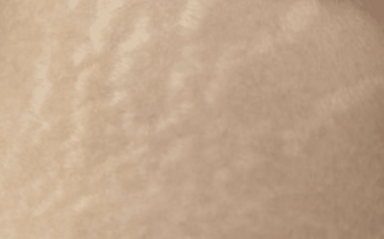 juvelook collagen skin booster for Stretch marks - Cienna Aesthetics