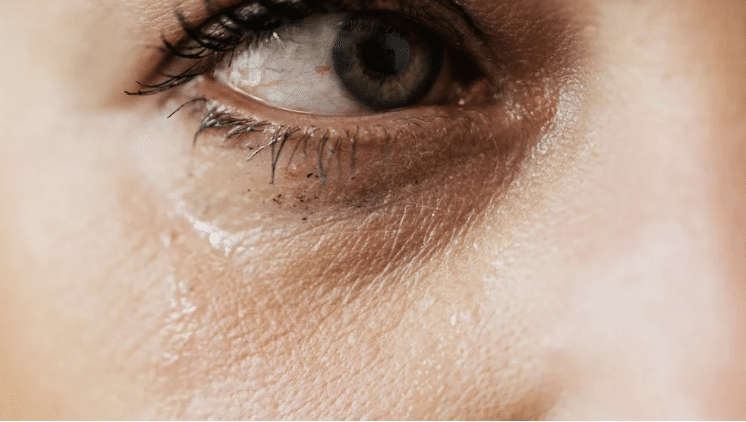 juvelook collagen skin booster for Loss of volume in the tear trough - Cienna Aesthetics