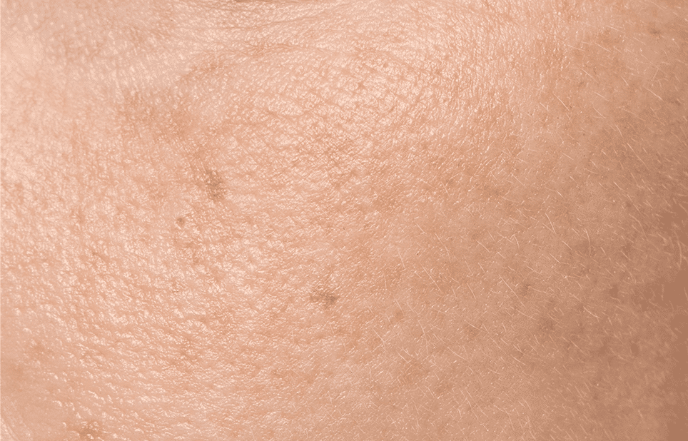 juvelook collagen skin booster for Dull Skin - Cienna Aesthetics