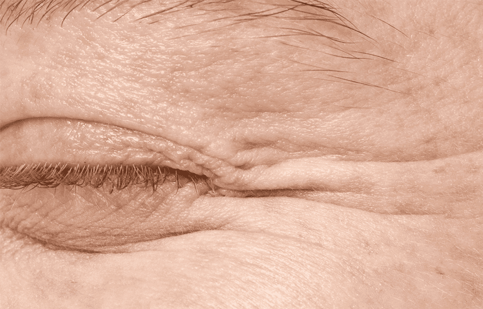 juvelook collagen skin booster for Wrinkles - Cienna Aesthetics