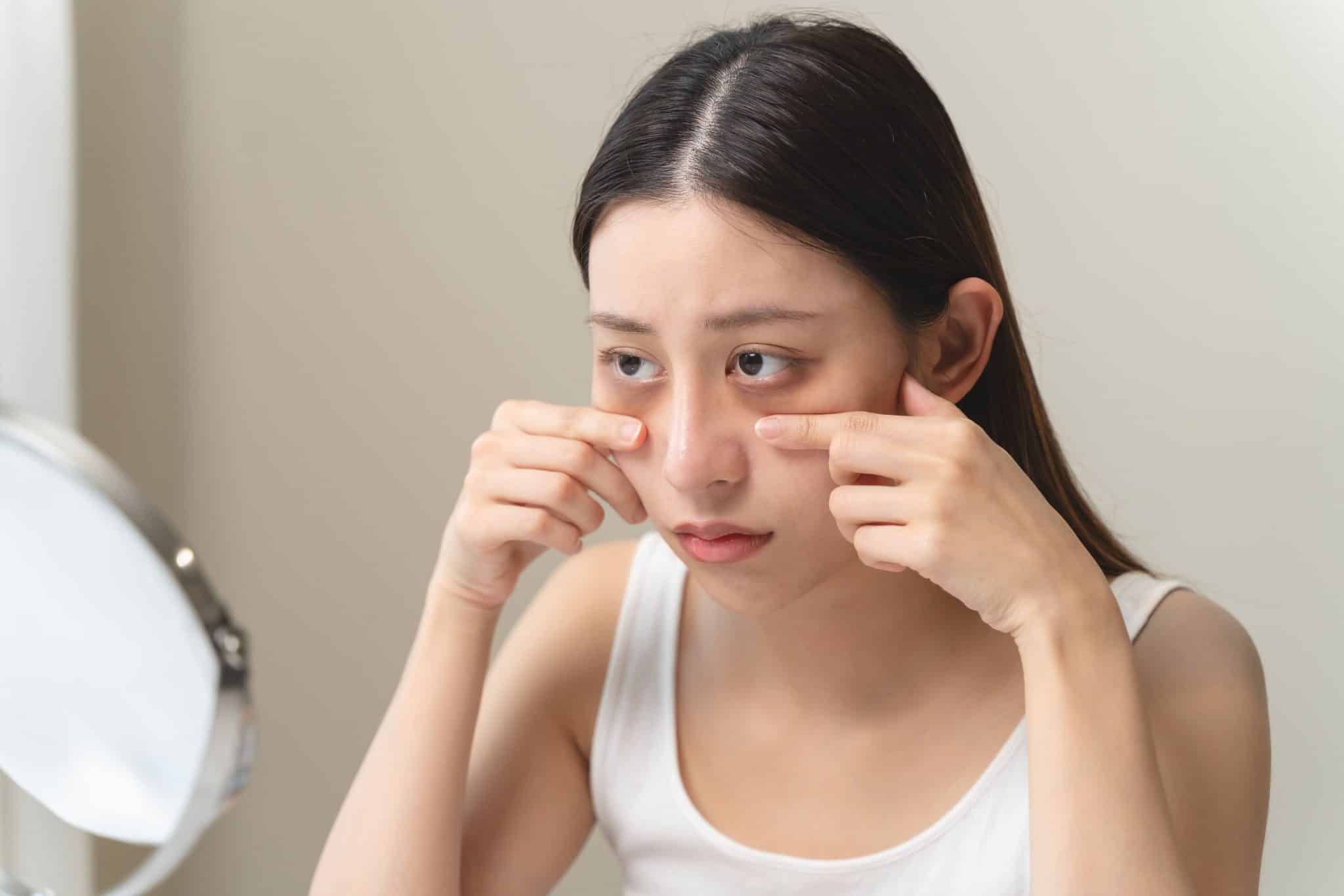 Cause of Dark Eye Circles - Genetics